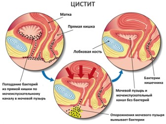 tsistit lecheniye simptomy prichiny (5)